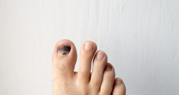Lotseril el medio del hongo de las uñas en los pies las revocaciones