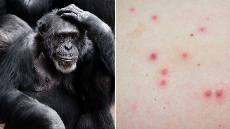 Viruela del mono no tarda en ser pandemia: OMS